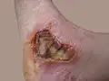 Eight day old third-degree burn caused by motorcycle muffler.