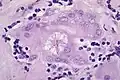 Asteroid body in sarcoidosis.