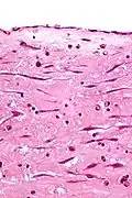 Atrial myxoma covered by endothelium. H&E stain.