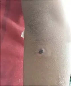 Hypopigmentation and a crusted erosion, elbow of a 5-year-old