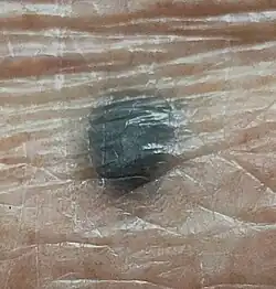 Blue nevus