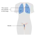 Stage 3 choriocarcinoma
