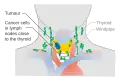 Stage N1a thyroid cancer
