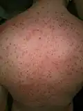 TENS Blisters on day 4