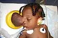 Encephalocele.