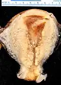 A stage III endometrioid adenocarcinoma that has invaded the myometrium