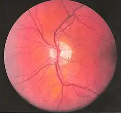Eye vessels