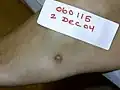 Foreign body granuloma