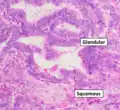 Grade 1: ≤5% solid non-glandular, non-squamous growth.[62]