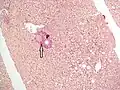 No fibrosis, but mild zone 3 steatosis, in which collagen fibres (pink–red, arrow) are confined to portal tracts (P) (Van Gieson's stain)[97]