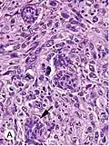 Invasive ductal carcinoma, with occasional entrapped normal ducts (arrow)
