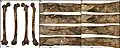 Burial 15. Perimortem fractures on the right femur