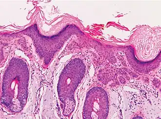 Superficially invasive cutaneous squamous-cell carcinoma. These lesions often do not show the marked pleomorphism and atypical nuclei of cSCC in situ, but manifest early keratinocyte invasion of the dermis.[12]