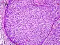 Gleason score 10 (5+5) with solid sheets of cells