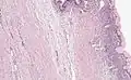 Mucinous cystadenoma of the pancreas