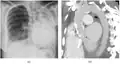 Extensive left-sided fibrothorax
