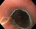 Self-expanding endoprosthesis