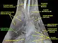 Flexor pollicis brevis muscle