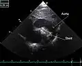 An echocardiogram of a stented persisting ductus arteriosus: One can see the aortic arch and the stent leaving. The pulmonary artery is not seen.
