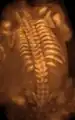Three-dimensional ultrasound image of the fetal spine at 21 weeks of pregnancy